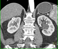 1 Cm Right Renal Cell Carcinoma- See Full Sequence - CTisus CT Scan