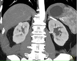 1 Cm Right Renal Cell Carcinoma- See Full Sequence - CTisus CT Scan