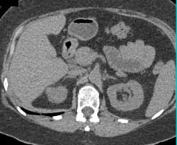 1 Cm Right Renal Cell Carcinoma- See Full Sequence - CTisus CT Scan