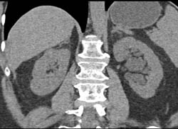 1 Cm Right Renal Cell Carcinoma- See Full Sequence - CTisus CT Scan