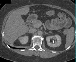 1 Cm Right Renal Cell Carcinoma- See Full Sequence - CTisus CT Scan