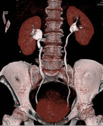 1 Cm Right Renal Cell Carcinoma- See Full Sequence - CTisus CT Scan