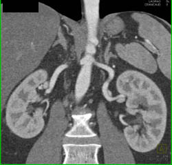 Duplicated Collecting System on the Left and Right- See Dilated Calyces on Left - CTisus CT Scan