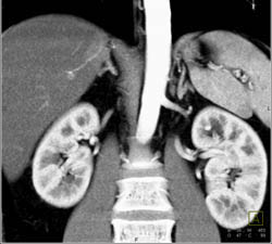 Duplicated Collecting System on the Left and Right- See Dilated Calyces on Left - CTisus CT Scan