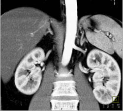 Duplicated Collecting System on the Left and Right- See Dilated Calyces on Left - CTisus CT Scan