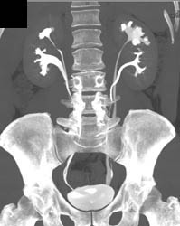 Duplicated Collecting System on the Left and Right- See Dilated Calyces on Left - CTisus CT Scan