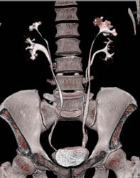 Duplicated Collecting System on the Left and Right- See Dilated Calyces on Left - CTisus CT Scan