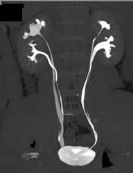 Duplicated Collecting System on the Left and Right- See Dilated Calyces on Left - CTisus CT Scan