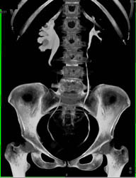 Dilated Right Renal Pelvis With CT Urogram - CTisus CT Scan