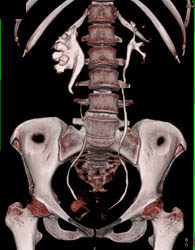 Dilated Right Renal Pelvis With CT Urogram - CTisus CT Scan