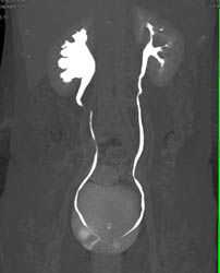 Dilated Right Renal Pelvis With CT Urogram - CTisus CT Scan