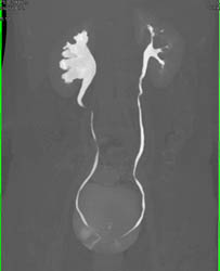 Dilated Right Renal Pelvis With CT Urogram - CTisus CT Scan