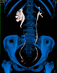 Dilated Right Renal Pelvis With CT Urogram - CTisus CT Scan