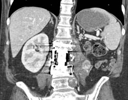 Metastatic Renal Cell Carcinoma to Left Paraspinal Muscle and Bone - CTisus CT Scan