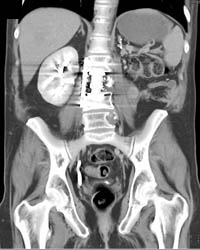 Metastatic Renal Cell Carcinoma to Left Paraspinal Muscle and Bone - CTisus CT Scan