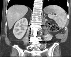 Metastatic Renal Cell Carcinoma to Left Paraspinal Muscle and Bone - CTisus CT Scan