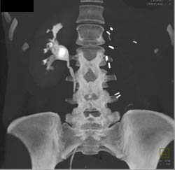 Metastatic Renal Cell Carcinoma to Left Paraspinal Muscle and Bone - CTisus CT Scan