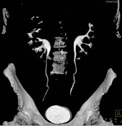 CT Urogram With VRT Imaging - CTisus CT Scan