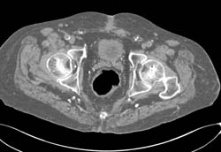 CT Cystogram With Reflux Into Anastomosis of Loop to Bladder - CTisus CT Scan