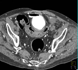 CT Cystogram With Reflux Into Anastomosis of Loop to Bladder - CTisus CT Scan