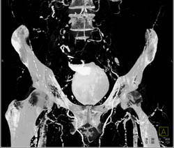 CT Cystogram With Reflux Into Anastomosis of Loop to Bladder - CTisus CT Scan