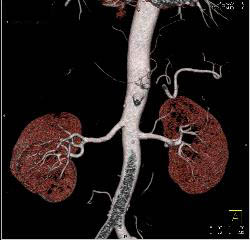 Normal CTA of Renal Arteries Using VRT and MIP Imaging - CTisus CT Scan