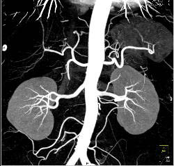 Normal CTA of Renal Arteries Using VRT and MIP Imaging - CTisus CT Scan