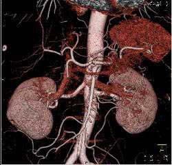 Normal CTA of Renal Arteries Using VRT and MIP Imaging - CTisus CT Scan