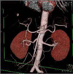 Normal CTA of Renal Arteries Using VRT and MIP Imaging - CTisus CT Scan