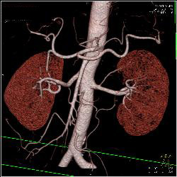 Normal CTA of Renal Arteries Using VRT and MIP Imaging - CTisus CT Scan