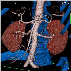 Normal CTA of Renal Arteries Using VRT and MIP Imaging - CTisus CT Scan