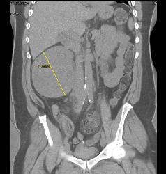 Renal Cell Carcinoma Without Significant Vascularity - CTisus CT Scan