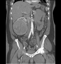 Renal Cell Carcinoma Without Significant Vascularity - CTisus CT Scan