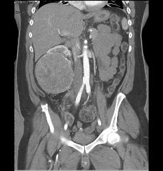 Renal Cell Carcinoma Without Significant Vascularity - CTisus CT Scan