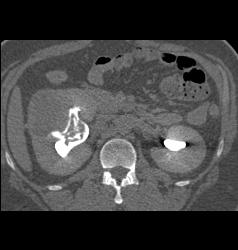 Blood in Renal Pelvis - CTisus CT Scan