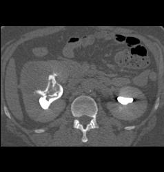 Blood in Renal Pelvis - CTisus CT Scan