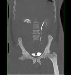 Blood in Renal Pelvis - CTisus CT Scan