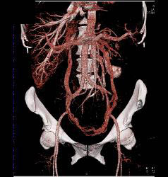 Pelvic Congestion Syndrome With Dilated Gonadal Veins - CTisus CT Scan