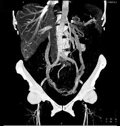 Pelvic Congestion Syndrome With Dilated Gonadal Veins - CTisus CT Scan