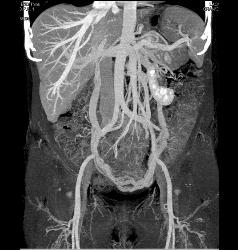 Pelvic Congestion Syndrome With Dilated Gonadal Veins - CTisus CT Scan