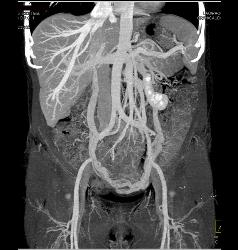 Pelvic Congestion Syndrome With Dilated Gonadal Veins - CTisus CT Scan