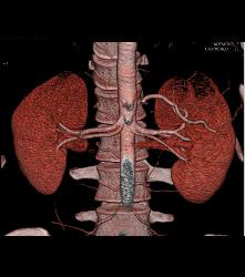 Multiple Renal Arteries in A Donor - CTisus CT Scan