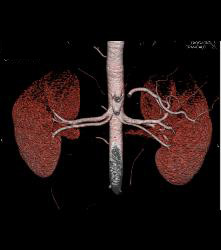 Multiple Renal Arteries in A Donor - CTisus CT Scan