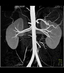 Multiple Renal Arteries in A Donor - CTisus CT Scan