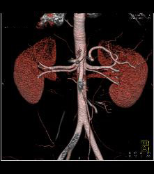 Multiple Renal Arteries in A Donor - CTisus CT Scan