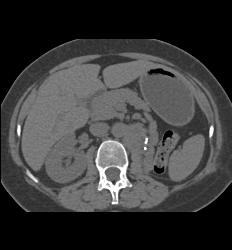 Recurrence of Renal Cell Carcinoma in Left Renal Bed - CTisus CT Scan