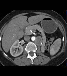 Recurrence of Renal Cell Carcinoma in Left Renal Bed - CTisus CT Scan