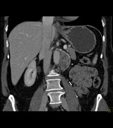 Recurrence of Renal Cell Carcinoma in Left Renal Bed - CTisus CT Scan