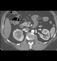 Vascular Right Renal Cell Carcinoma - CTisus CT Scan