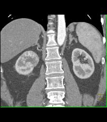 Vascular Right Renal Cell Carcinoma - CTisus CT Scan